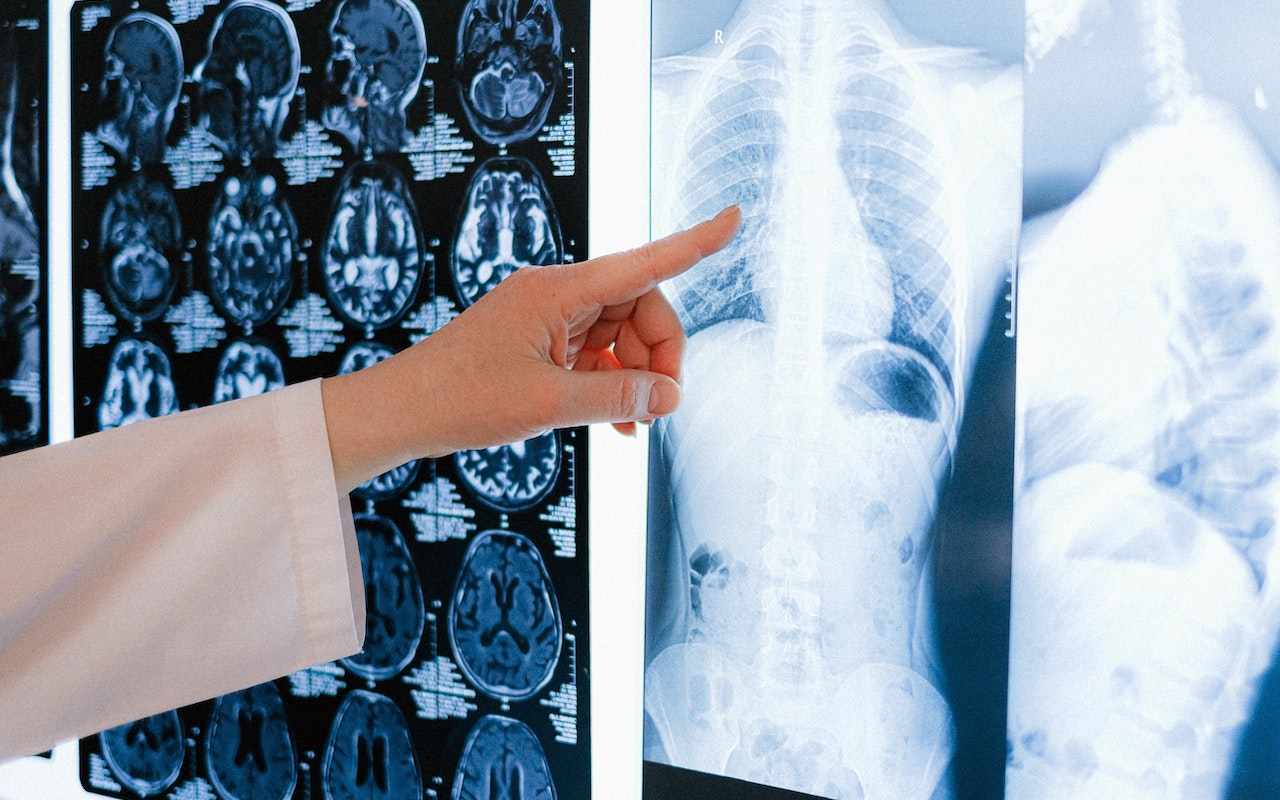 Radioterapia jest metodą leczenia chorych na nowotwory polegającą na zastosowaniu wiązki promieniowania jonizującego.