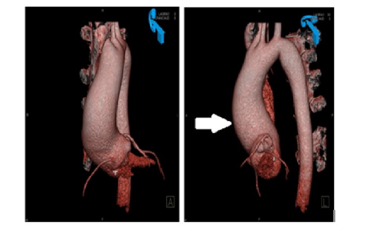 Tętniak aorty wstępującej (strzałka) uwidoczniony w badaniu angio-CT aorty.