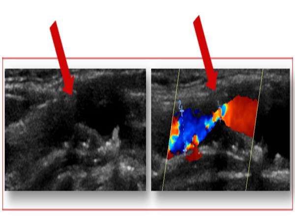 Ultrasonografia ttnic dogowowych przedstawiajca istotne zwenie ttnicy szyjnej wewntrznej 600x450