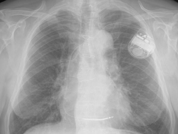 Zdjcie rentgenowskie klatki piersiowej pacjenta z rozrusznikiem serca600x450