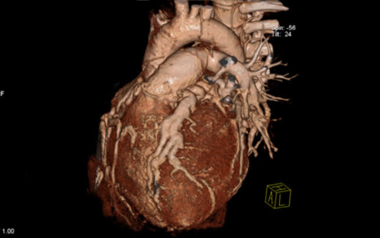 Badanie MSCT tętnic wieńcowych. Nieprawidłowe odejście lewej tętnicy wieńcowej od pnia płucnego (strzałka) w 25 letniej chorej przed leczeniem chirurgicznym.
