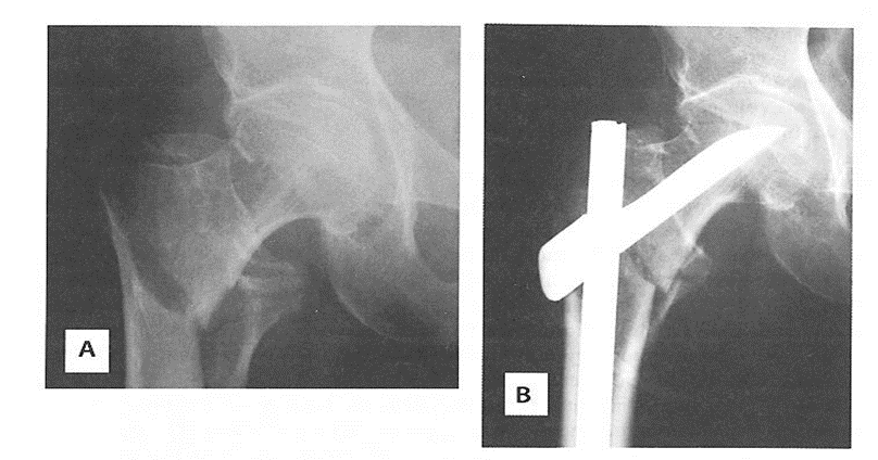 RTG złamania i zespolenia złamania BKKU u pacjentki z osteoporozą (8)